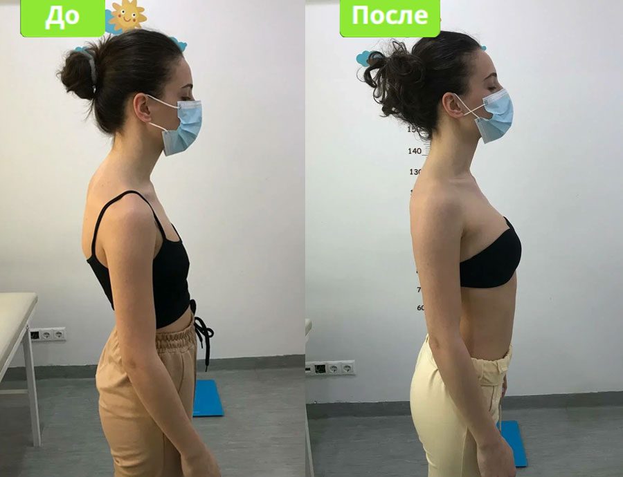 Эффективность Биомеханотерапия до и после